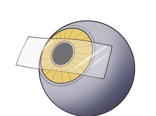 1724212973898159.jpg 晶体植入.jpg