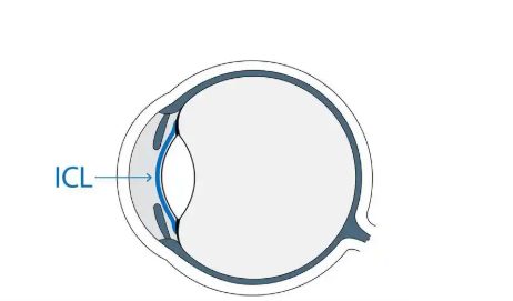 1736251374299974.jpg 晶体植入6.jpg