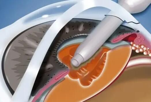 1736264335792412.jpg 晶体植入3.jpg