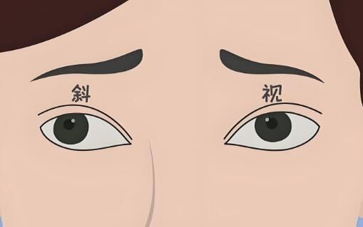 1736265734351142.jpg 斜视手术.jpg